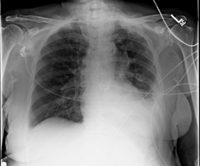 An Unusual Source of Systemic Thromboembolism :: Science Publishing Group